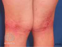 eczema-atopic-dermatitis-dermnet NZ