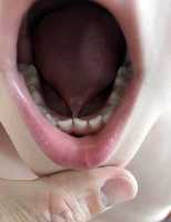 ankyloglossia - tongue tied