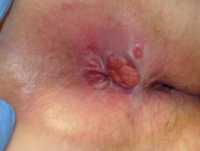 Example of Anal Cancer: DermNZ image