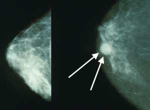 Mammograms showing a normal breast (left) and a breast with cancer (right, white arrows). Wikipedia Image