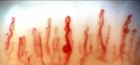 Nailfold Capillaroscopy Dr. Ritch