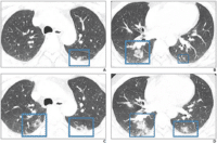 A and B, Initial CT images obtained show small round areas of mixed ground-glass opacity and consolidation (rectangles) at level of aortic arch (A) and ventricles (B) in right and left lower lobe posterior zones. C and D, Follow-up CT images obtained 2 days later show progression of abnormalities (rectangles) at level of aortic arch (C) and ventricles (D), which now involve right upper and right and left lower lobe posterior zones.