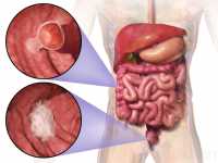 colon-cancer-wikipedia-image