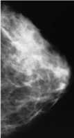 normal-mammogram-cdc-image