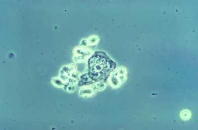 This photomicrograph of a wet mount-prepared vaginal discharge specimen, revealed the presence of a grouping of Trichomonas vaginalis parasitic protozoa, in this case of trichomoniasis. CDC Image