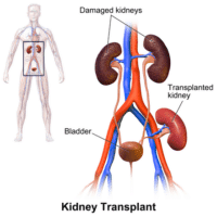 Kidney Transplant Wikipedia image