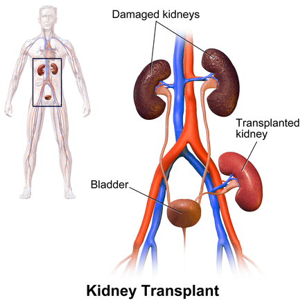 Kidney Transplant Wikipedia image