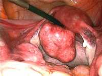 One example of a large fibroid-Wikipedia image