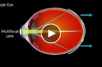 blink-study-of-multifocal-contacts-for-myopia-control