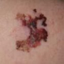 One example of melanoma from DermNet NZ