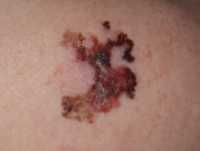 One example of melanoma from DermNet NZ