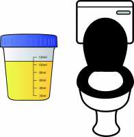 urine-test-biomarker-bladder-cancer