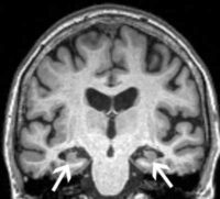 Anxiety Associated with Faster Alzheimer's Disease Onse