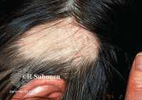 Example of Alopecia Areata DermNetNZ