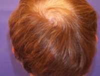 male-pattern-hair-loss-dermnet-image