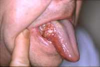 oral cancer Wikipedia image