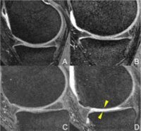 MR images of the right knee (A, B, C, D) at baseline (A, C) and after 48 months (B, D). Overweight 47-year-old woman in the elliptical trainer group (A-B) and overweight 64-year-old man in the racket sports group (C-D). The man in the racket sports group developed severe cartilage damage at the femur and tibia bones (arrowheads). In contrast, no cartilage damage was seen in the woman in the elliptical trainer group (A-B).