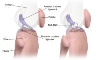 ACL_Tear-wikipedia-image