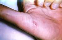 CDC image of Bartonella henselae hand lesion