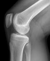 knee-x-ray-wikipedia-image.jpg
