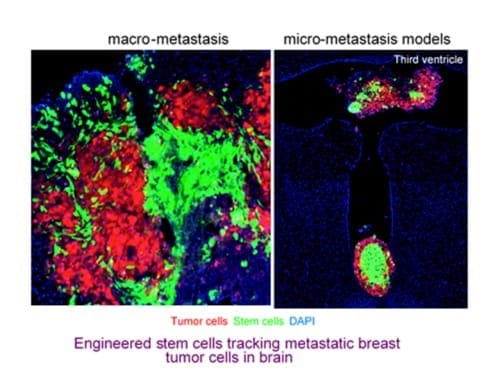 tem Cells Target Breast Cancer that Metastasizes to the Brain 