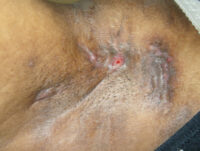 Hidradenitis suppurativa: DermNetNZ image