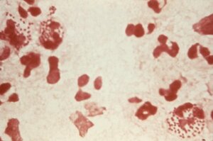 CDC Image and Caption:This photomicrograph of a Gram-stained specimen revealed the presence of Gram-negative, Neisseria gonorrhoeae intracellular diplococci, leading to a positive diagnosis of gonorrhea.