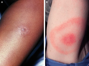 Erythema Migrans on Skin of Different Colors. Panel A shows an erythematous nodule; Panel B shows erythema migrans. The image in Panel A is reprinted from Bhate C, Schwartz RA. Lyme disease: Part I. Advances and perspectives. J Am Acad Dermatol 2011;64:619-36, with permission from Elsevier. The image in Panel B is from the Centers for Disease Control and Prevention/James Gathany.