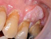 oral-cancer-dermnet-image