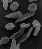 Some sickle and some normal red blood cells: Wikipedia image