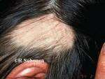 alopeca-areata-dermnet-nz-image