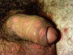 One example of secondary syphilis