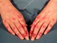 dermatomyositis-hand-2__dermnet-image