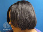 hair-straightener-dermnet image
