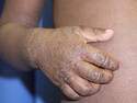 Example of Eczema-Atopic Dermatitis DermNet NZ Image MedicalResearch.com: