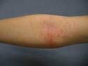 One Example of Eczema-Atopic DermatitisDermNet NZ Image