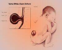spina-bifida-_neural-tube-cdc-image