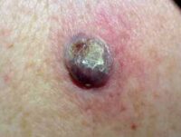 nodular-melanoma-0001__ProtectWyJQcm90ZWN0Il0_FocusFillWzI5NCwyMjIsIngiLDFd