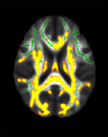 This figure shows increased neuroinflammation (yellow colors) associated with higher hidden fat (visceral fat) in the cohort of 54 participants with an average age of 50 years in the brain’s white matter. The green colors are the normal white matter