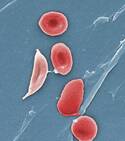 sickle-cell-cdc-phil-image