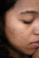 hyperpigmentation-dark-spots_pexels-ron-lach-9253763