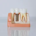 dental-implants-pexels-photo-6502306