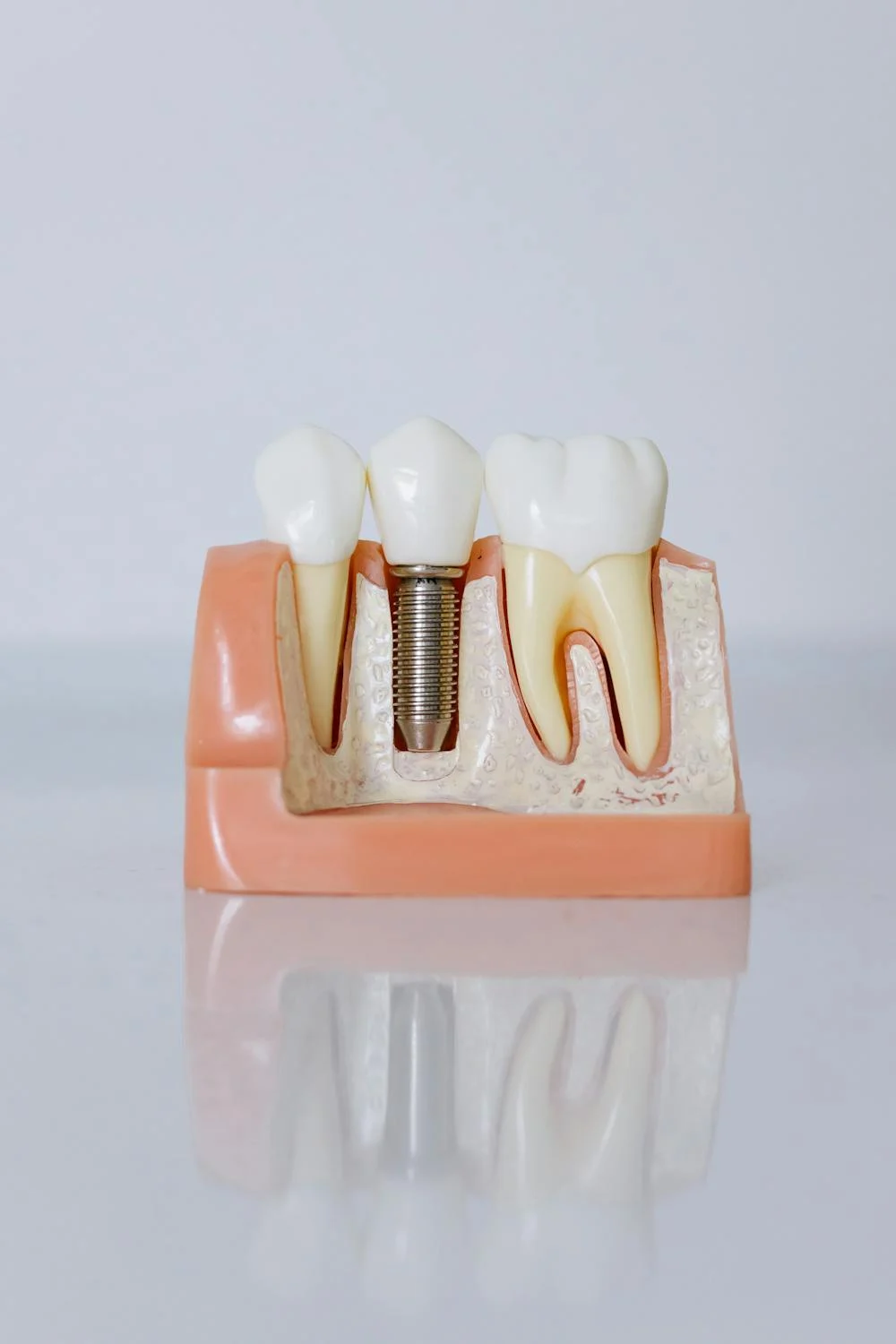 dental-implants-pexels-photo-6502306