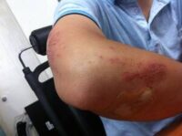 occupational-injuries-rash