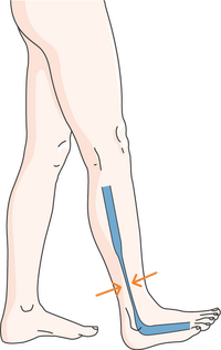 Preventing varicose veins involves a combination of healthy lifestyle choices, daily habits, and sometimes medical interventions