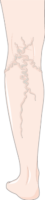 varicose-veins_vein_varices-152x680