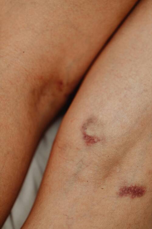 bruises-accidents-lawyers