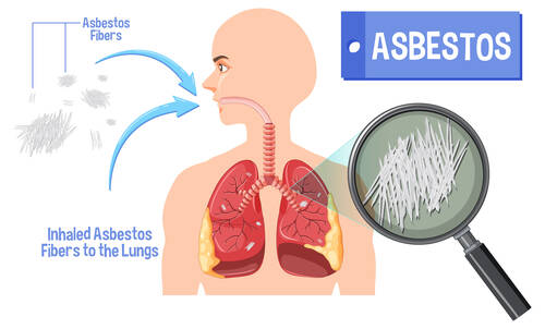 mesothelioma-asbestoses-freepik_fidh_iu8g_220606