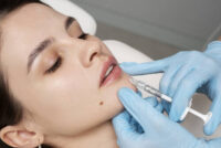 dermal fillers