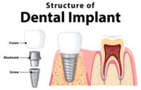 structure-dental-implant